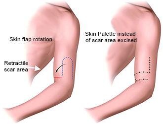 Retractile-scar